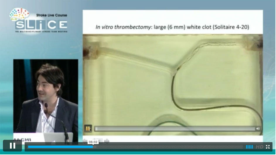 vitro thrombectomy : large (6mm)